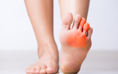 Come liberarsi del neuroma di Morton?